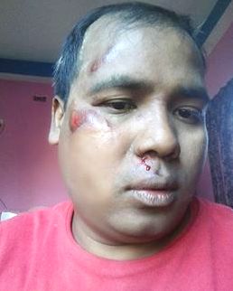 पत्रकार सन्तकुमार चौधरी मोटरसाईकल दुर्घटनामा, अवस्था सामान्य
